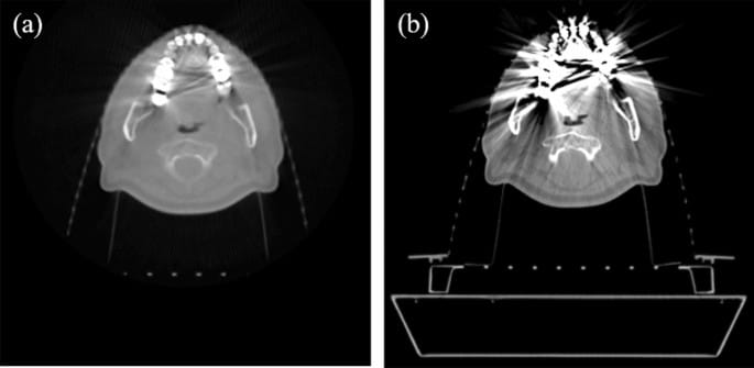 Eliminación artefactos metálicos CBCT