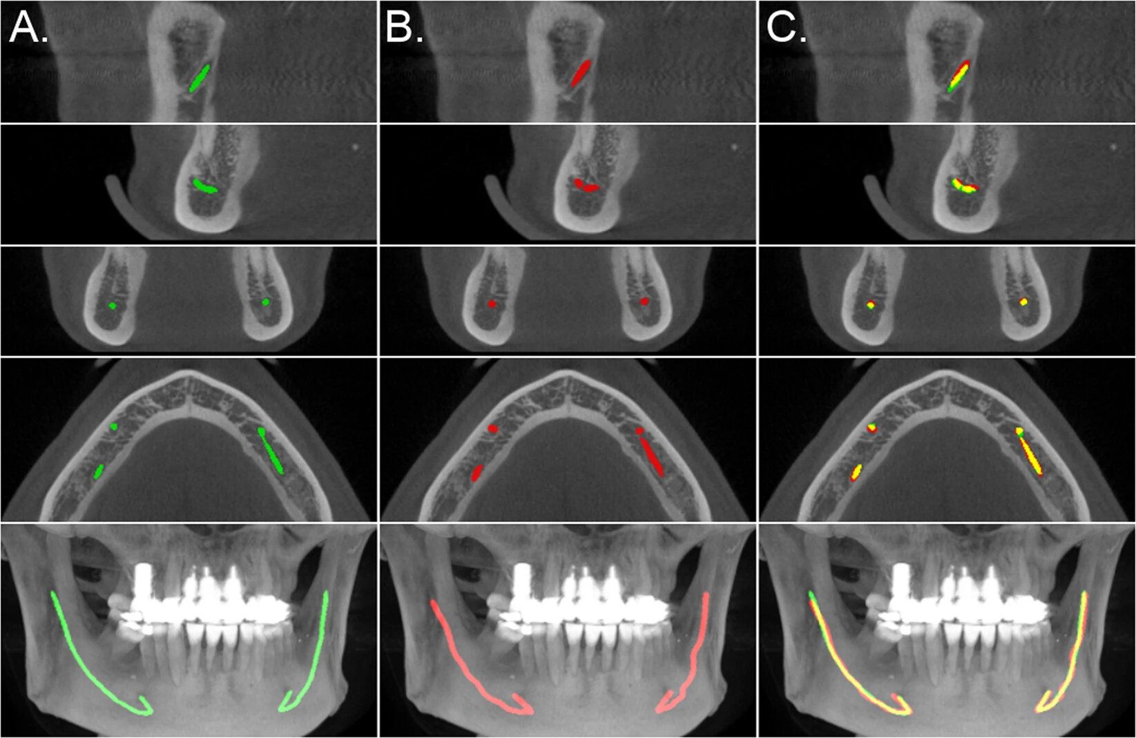 Marcado nervio mandibular IA