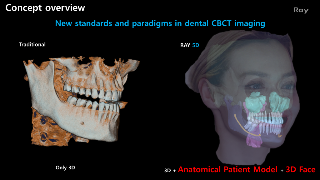 RAY 5D vs Traditional CBCT